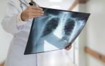 Cancer du poumon des non fumeurs : un nouveau médicament montre des résultats 