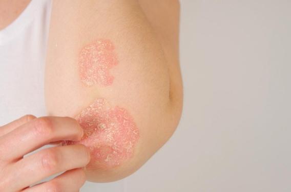 Comment le psoriasis peut devenir une maladie ...