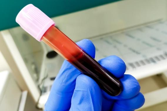 SEP : un nouveau test sanguin pour mesurer la réponse immunitaire au virus d'Epstein Barr