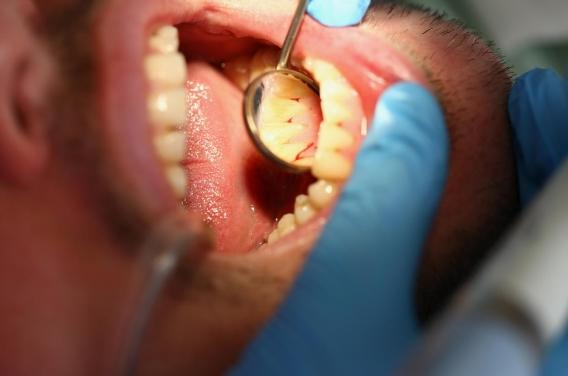 Maladie parodontale : les statines pourraient réduire l’inflammation des gencives