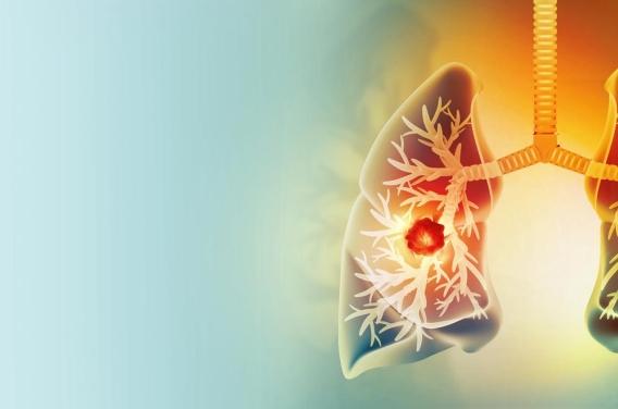 Cancer du poumon : quel impact sur la  ...