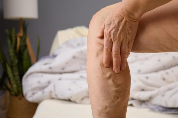 Varices : pourquoi ces traitements doivent être utilisés avec prudence 
