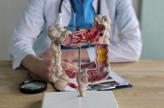 Ses symptômes cachaient un cancer colorectal ...