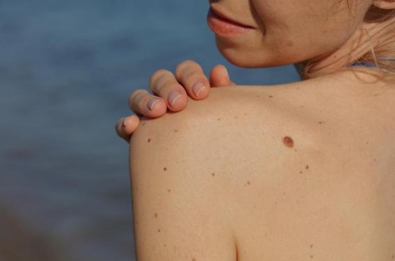 Grains de beauté : comment vérifier soi-même qu’ils ne sont pas cancéreux