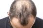Perte de cheveux et calvitie : quelles sont les causes de l'alopécie ?