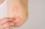 Psoriasis : pourquoi certains malades ne répondent-ils jamais aux traitements ?