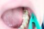 Et si les caries pouvaient bientôt disparaître sans plombage ?