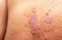 Psoriasis : l’incidence de la maladie va grimper jusqu’en 2050