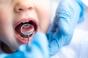 Prévention des caries : vers le remboursement de nouveaux actes