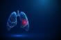 Cancer du poumon : ces infections courantes pourraient augmenter les risques