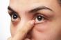 Sécheresse oculaire : le microbiote de vos yeux pourrait jouer un rôle