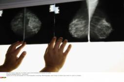 Cancer du sein : la double mastectomie n’améliore pas la survie