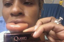 Une jeune femme victime d’un angioedème à cause d'un baume à lèvres