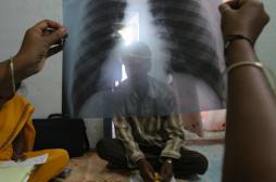 Tuberculoses multirésistantes : 98 % de laissés pour compte