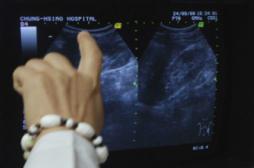 Calculs rénaux : l'opération peut déboucher sur de coûteuses complications 