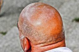 Un médicament contre le cancer efficace pour traiter la calvitie