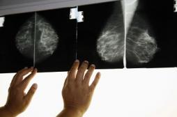 L'excès de cholestérol aggraverait le cancer du sein