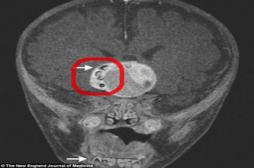 Des dents dans le cerveau d’un bébé à cause d’une tumeur 