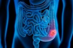 Cancer du colon : l’hérédité ne concerne pas que les proches au premier degré  