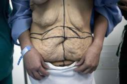 Chirurgie bariatrique : la chirurgie plastique booste son efficacité