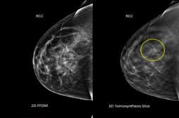 La mammographie en 3D améliore le dépistage du cancer du sein 