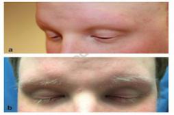 Calvitie : un médicament contre l'arthrite fait repousser poils et cheveux