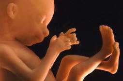 Un fœtus dans la vessie