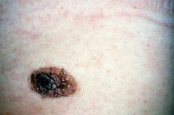 Le nombre des cancers de la peau explose au Royaume-Uni