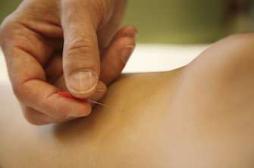 Acupuncture :plus efficace si on y croit