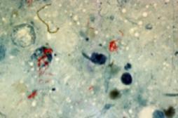 Tuberculose : aux origines des souches multi-résistantes