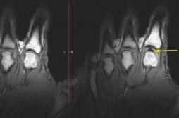 Le mystère des craquements de doigts résolu grâce à l'IRM