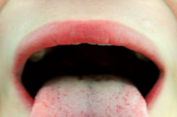 Dépister le diabète en analysant l'haleine