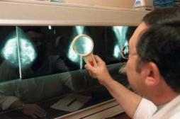 Un traitement contre l’épilepsie efficace dans le cancer du sein