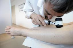Mélanome : les hommes célibataires sont diagnostiqués plus tard