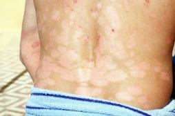 La sédentarité en cause dans la progression du psoriasis
