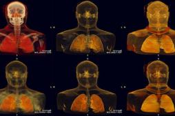 Cancer bronchique: tripler le nombre de guérisons 