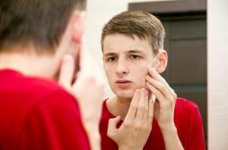 Une nouvelle piste thérapeutique pour traiter l’acné ?