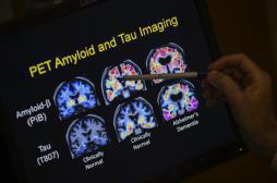 Alzheimer : les plaques amyloïdes altèrent la mémorisation