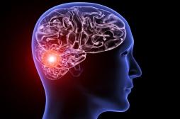 Anévrisme cérébral: un capteur sans fil implanté dans les vaisseaux pour surveiller la guérison