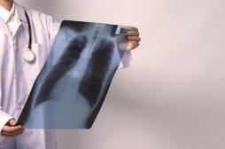 Dépistage du cancer du poumon : 