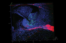 Un implant cochléaire amélioré permet de retrouver une ouïe fine