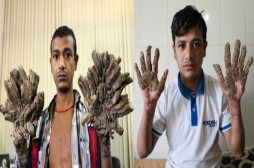 Abul Bajandar : l'homme arbre a subi 16 opérations