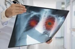 Maladies cardiovasculaires : grâce à l'IA, le risque détecté avec le dépistage du cancer du poumon 