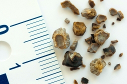 Quand des recherches sur la pluie nous aident à détruire les calculs rénaux…