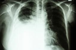 Cancer du poumon : le dépistage inutile chez les fumeurs
