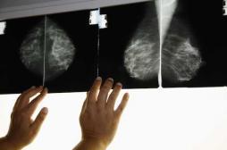 Cancer du sein :  22 séances de rayons effectuées du mauvais côté