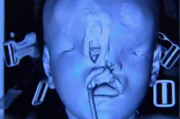 L'enfant né sans visage a été opéré avec succès