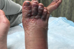 Le voyage de rêve qui se termine avec des vers parasites plein les pieds