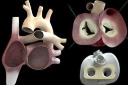 Coeur artificiel : décès du troisième patient implanté 