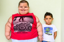 Syndrome de Prader-Willi : un Brésilien pèse 80 kg à 5 ans